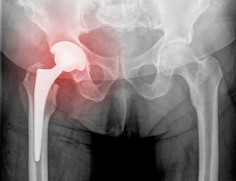 hip replacement